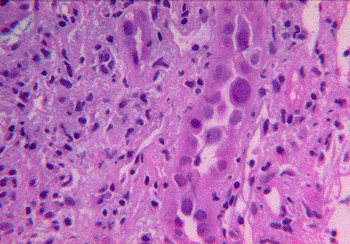 Imagen: El virus BK en las células de epitelio renal (Fotografía cortesía del Colegio Americano de Patología).
